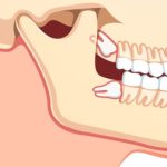 چرا باید دندانهای نهفته و نیمه نهفته را خارج نمایید ؟