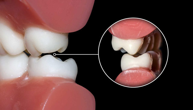 علل دندان قروچه