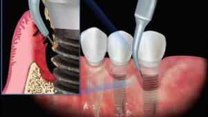 ایمپلنت دندان با لیزر چیست و چه مزایایی دارد؟