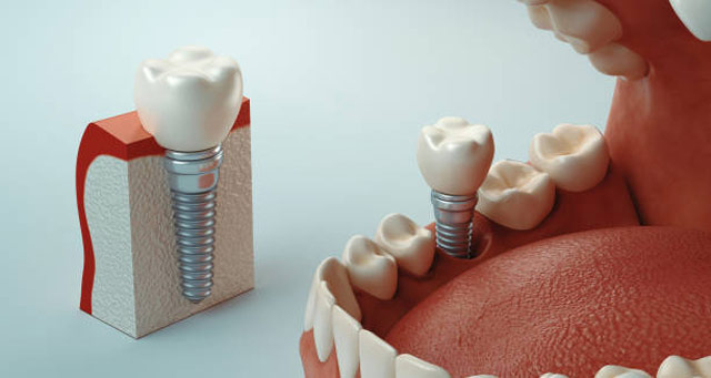 علائم نیاز به کاشت ایمپلنت دندان چیست؟
