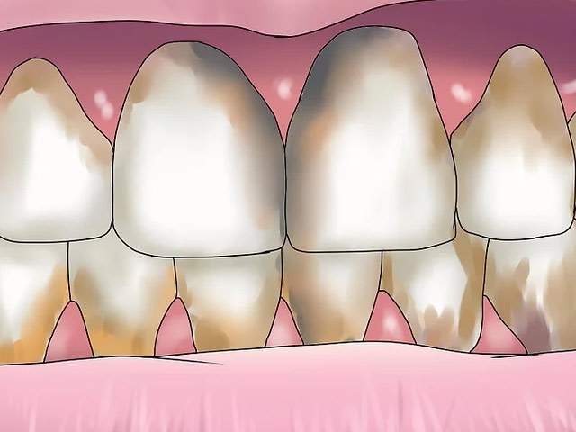 بیماری شدید لثه یکی از دلایل اصلی از دست دادن استخوان دندان فك است