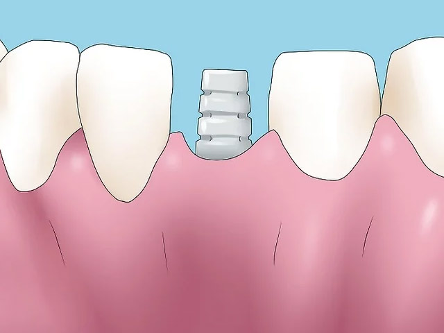 معکوس کردن از دست دادن استخوان دندان فك با كمك روشهای پزشکی