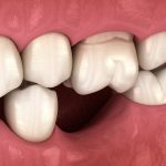 چگونه از دست دادن استخوان دندان در فك را معكوس كنيم؟