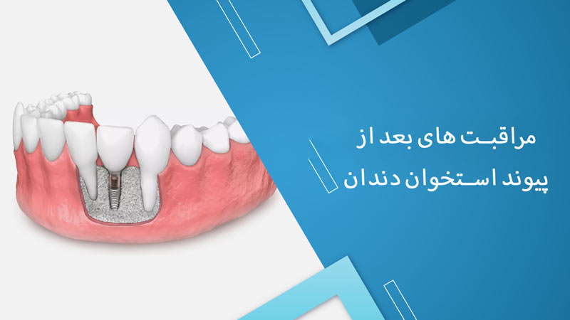 مراقبت های بعد از جراحی پیوند استخوان دندان