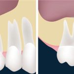 تفاوت پیوند استخوان دندان و لثه و سینوس لیفت چیست؟
