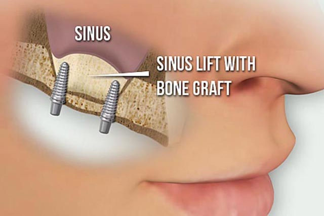 تفاوت پیوند استخوان دندان و لثه و سینوس لیفت