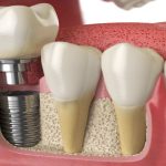 روکش های دندانی چگونه به ایمپلنت ها متصل می شوند؟