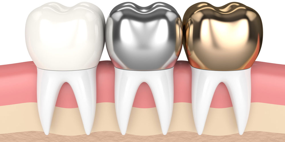 انواع روکش‌ دندان