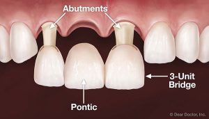 بریج دندان(پل دندانی) چیست؟