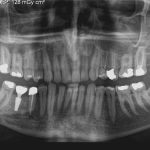 گزارش جراحی کیست وسیع دور تاج دندان عقل نهفته راست پایین