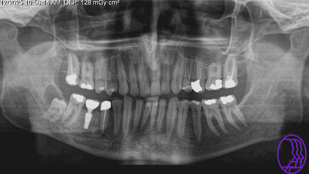 گزارش جراحی کیست وسیع دور تاج دندان عقل نهفته راست پایین