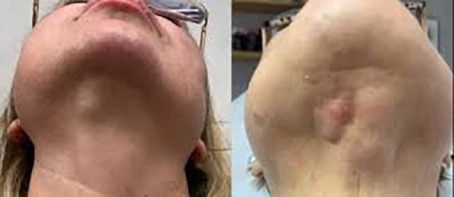 عوارض اندولیفت در ناحیه گردن