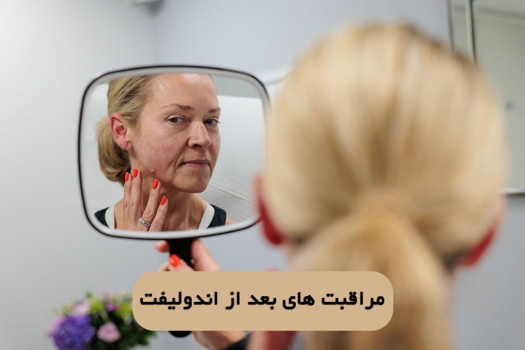 مراقبت‌های پس از انجام اندولیفت