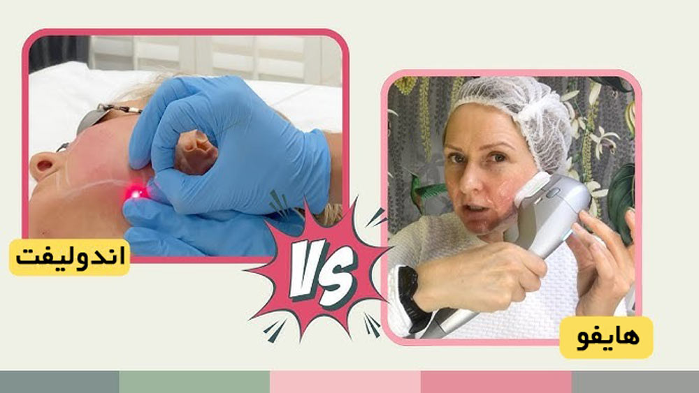 اندولیفت یا هایفو