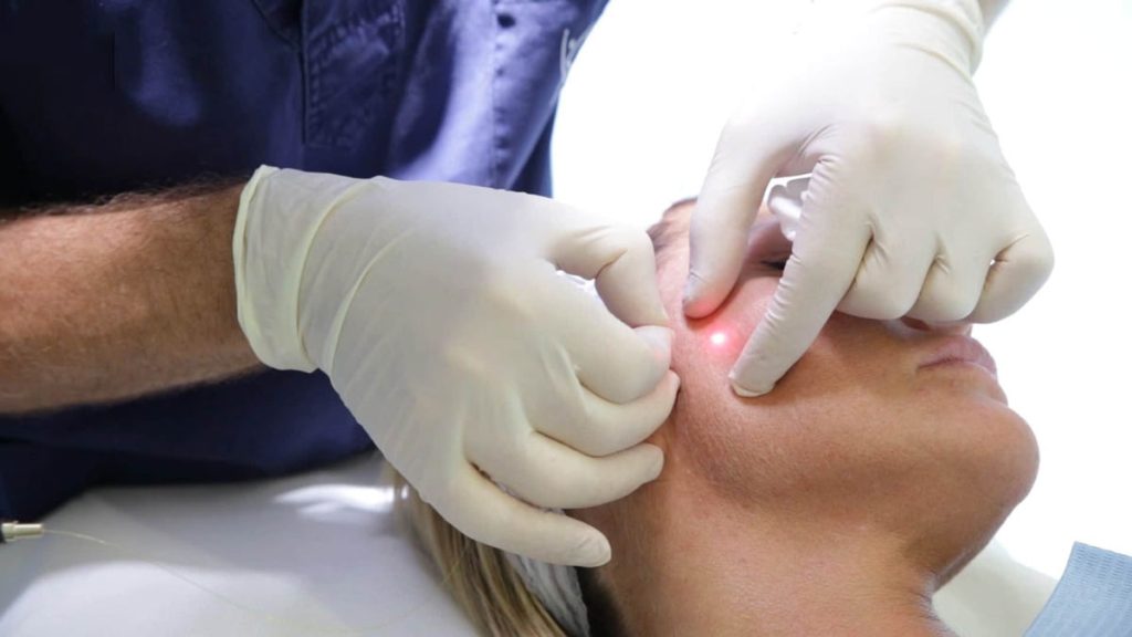 نحوه انجام اندولیفت