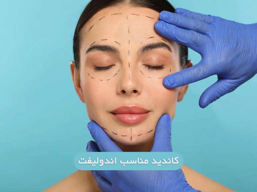 کاندید مناسب اندولیفت