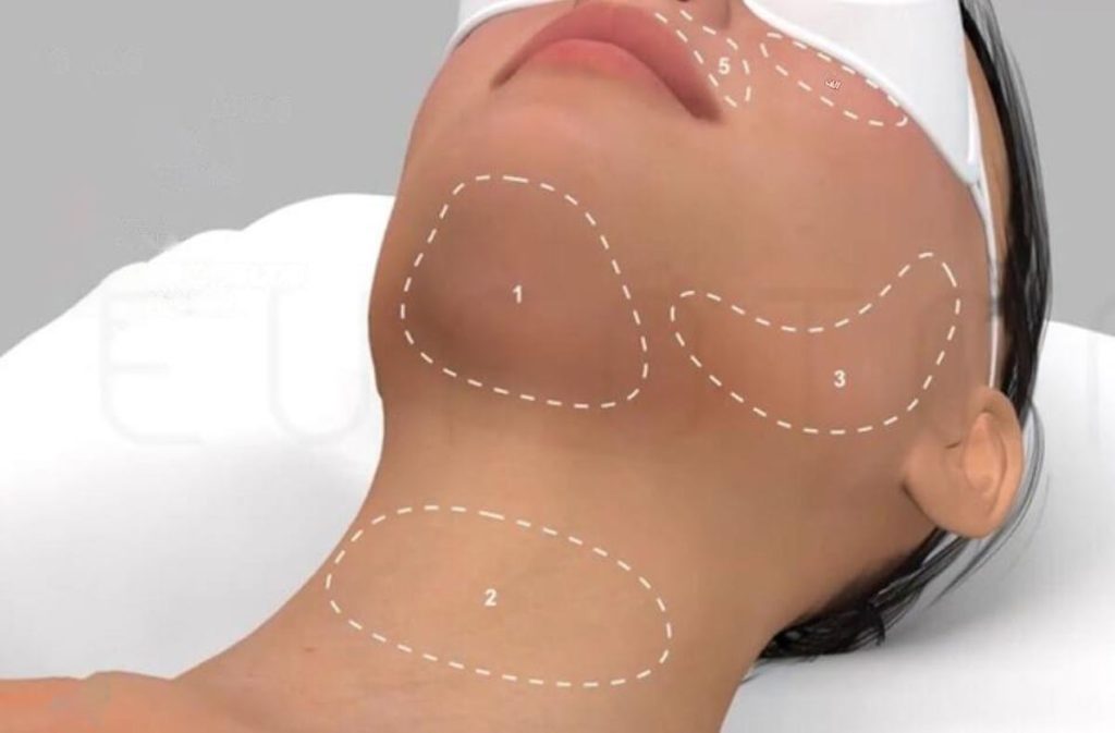 نواحی مناسب برای انجام اندولیفت