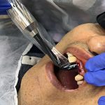 گزارش عمل خارج کردن دو ریشه جلوی فک بالا و کاشت دو واحد ایمپلنت در یک جلسه