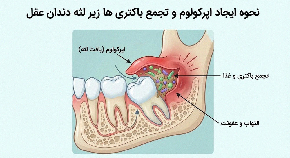 نمودار اپرکولوم دندان عقل و تجمع باکتری زیر لثه