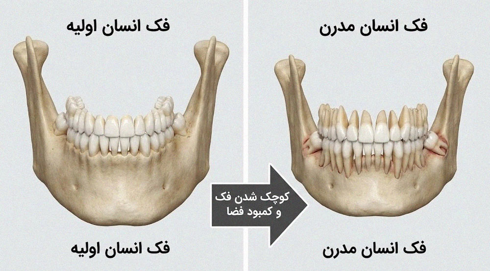 مقایسه فک انسان اولیه و مدرن - علت کمبود فضا برای دندان عقل
