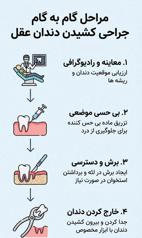 مراحل گام به گام جراحی کشیدن دندان عقل نهفته