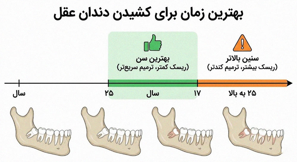بهترین سن برای کشیدن دندان عقل - مقایسه ریسک عوارض در سنین مختلف

