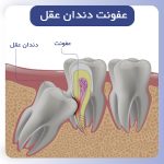 عفونت دندان عقل: علائم، تشخیص، درمان خانگی و پزشکی