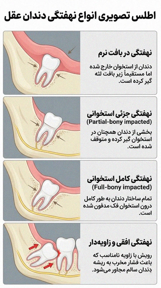 اطلس تصویری انواع نهفتگی دندان عقل