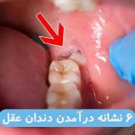 ۶ نشانه درآمدن دندان عقل