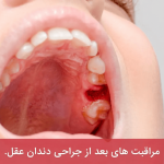 مراقبت های بعد از جراحی دندان عقل تا بهبودی