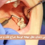 جراحی دندان عقل نهفته توسط جراح فک و صورت