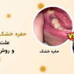 حفره خشک دندان چیست و چطور درمان میشود؟