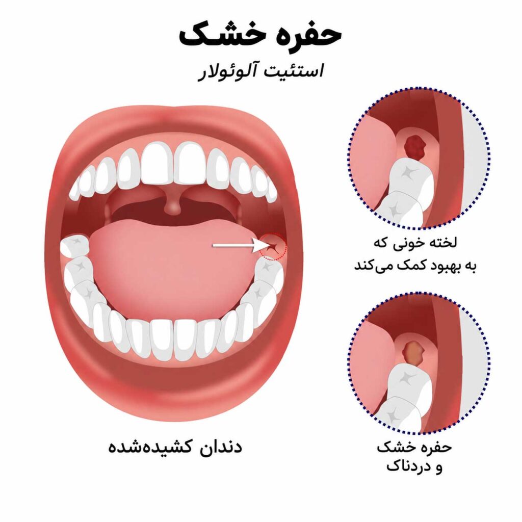 آناتومی حفره خشک