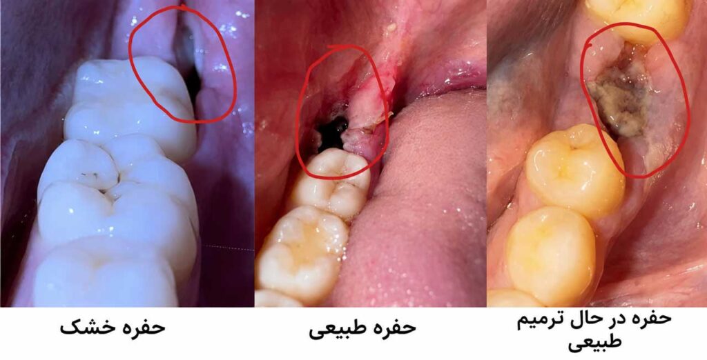 مقایسه حفره خشک با حفره طبیعی و حفره در حال بهبود