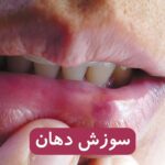 سوزش دهان چیست؟ علت‌ها، علائم و روش‌های درمان