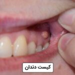 کیست دندان: راهنمای کامل علائم، انواع و درمان