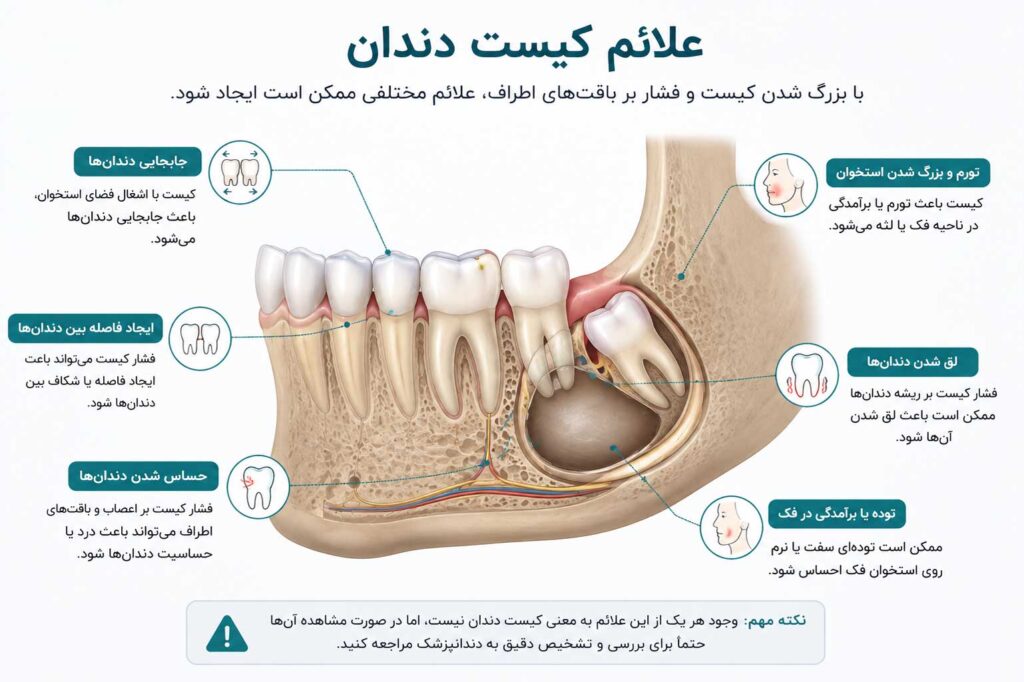 علائم کیست دندان