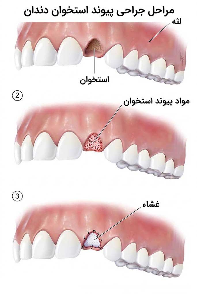 مراحل جراحی پیوند استخوان دندان با ماده پیوندی و ممبران هدایت کننده ترمیم