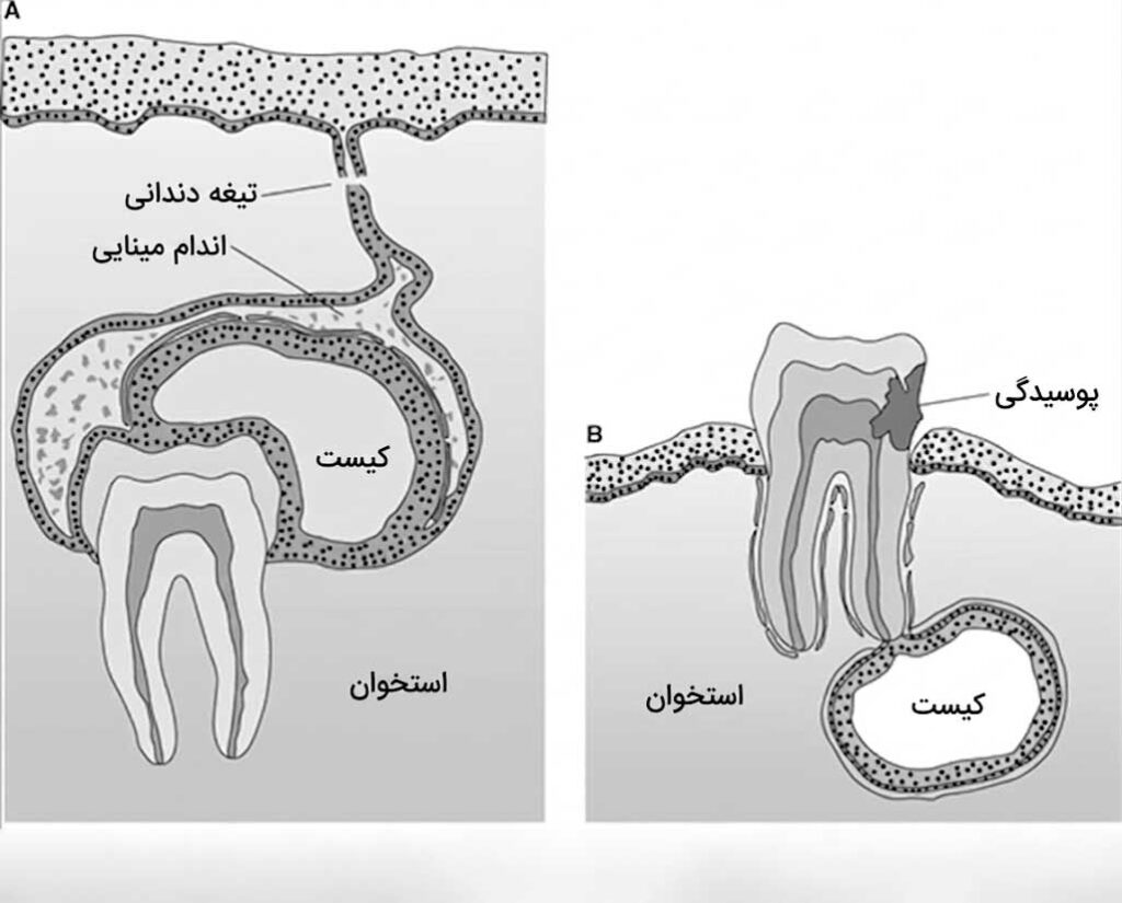 محل تشکیل انواع کیست دندان در فک