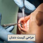 جراحی کیست دندان در تهران: روش ها، عوارض و مراقبت ها